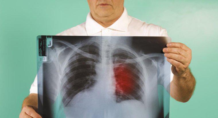 Co to jest rokowanie dla trzeciego stadium raka płuc?