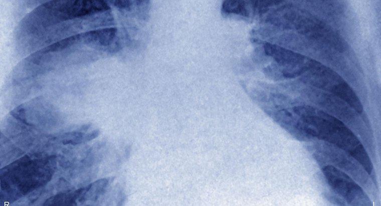 Co to jest chłoniak płuc?