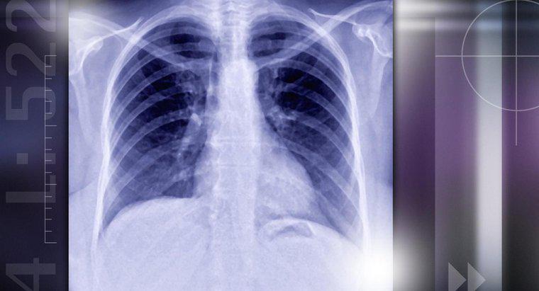 Co powoduje guzki płuca?