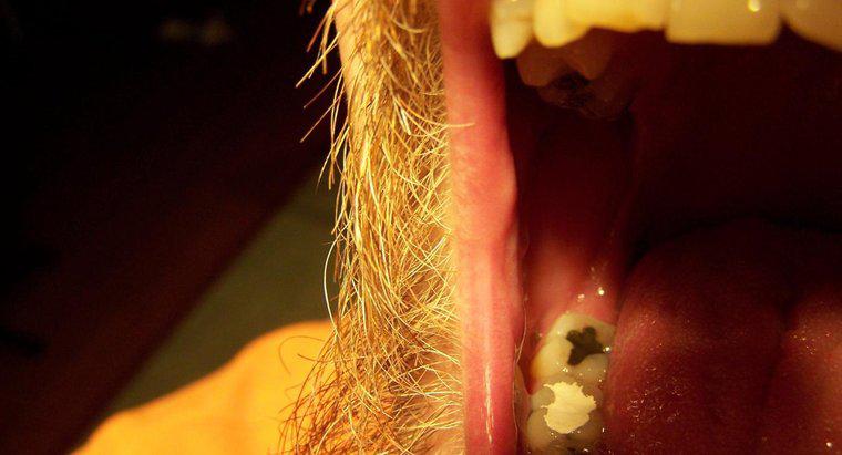 Jak zrobić domowe wypełnienie zębów?