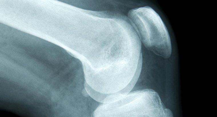 Jakie są najstarsze objawy raka kości?