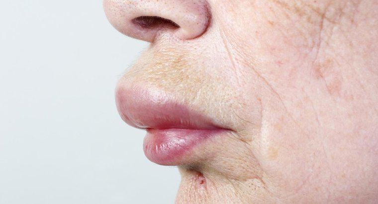 Jak leczyć obrzęk wargi i twarzy?