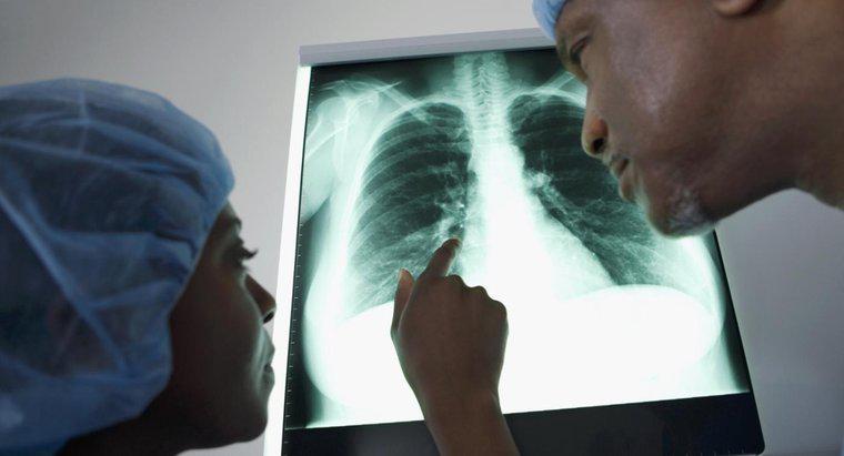 Jakie są różne opcje leczenia płynów w płucach?