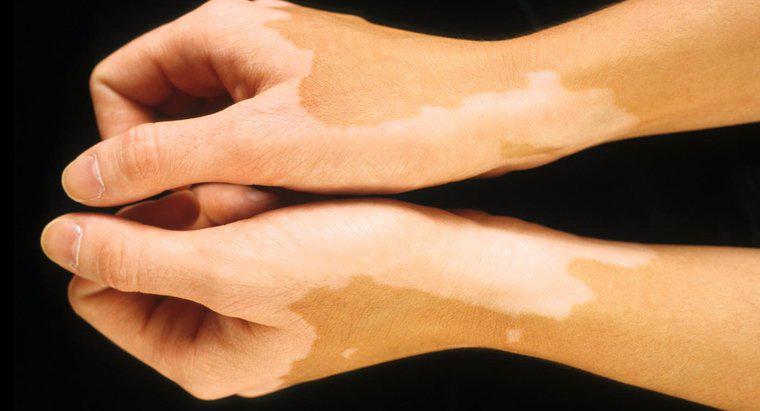 Jakie są rodzaje chorób przebarwień skóry?