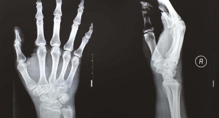 Jakie są objawy złamanego kciuka?