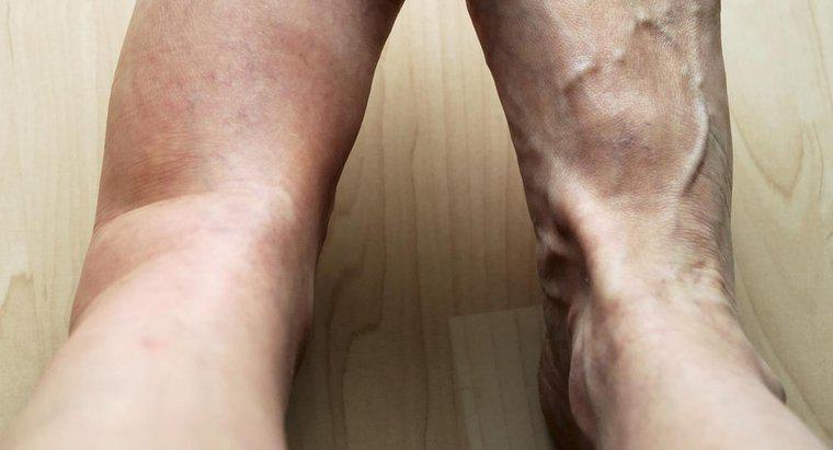 Jakie są możliwe przyczyny bólu i obrzęku w lewej nodze?