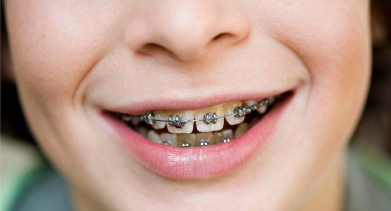W jaki sposób kolczyki w języku wpływają na aparaty ortodontyczne?
