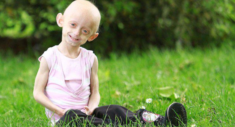 Jakie są interesujące informacje o Progerii?