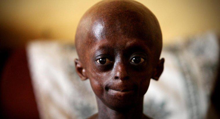 Jakie ograniczenia ma osoba z Progeria?