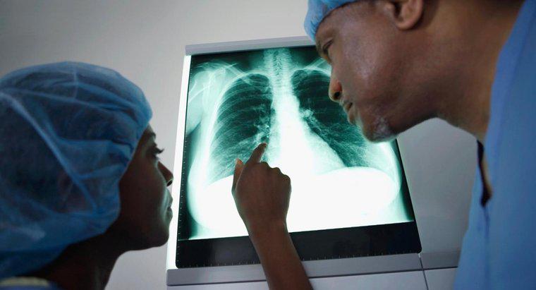 Jakie objawy są charakterystyczne dla raka płuc?