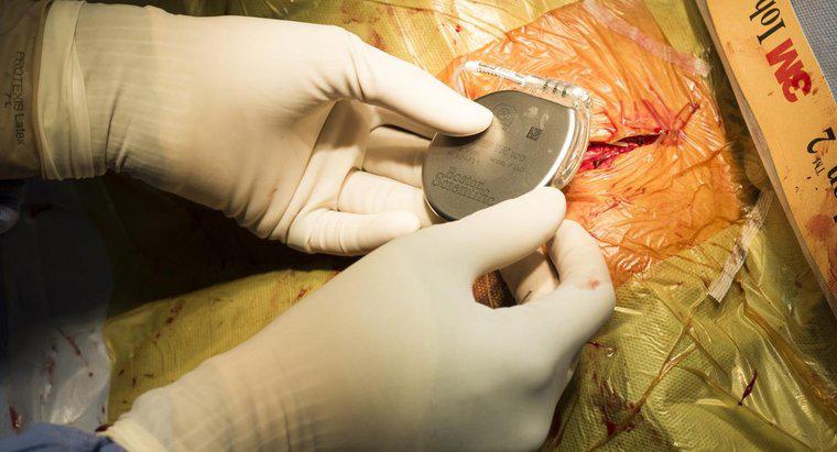 Jaki jest proces regeneracji pacjentów z problemami z pacemaker Surgery?
