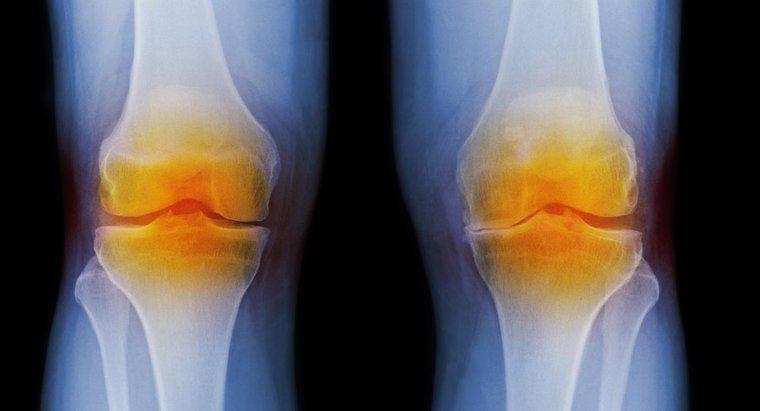 Jakie są objawy zapalenia stawów w kolanie?