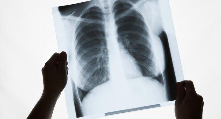 Co powoduje białe plamy w płucach?