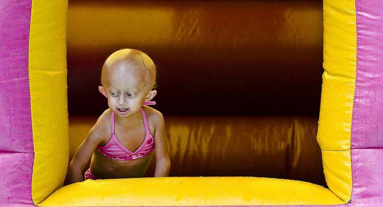 Jak długo możesz żyć z Progerią?