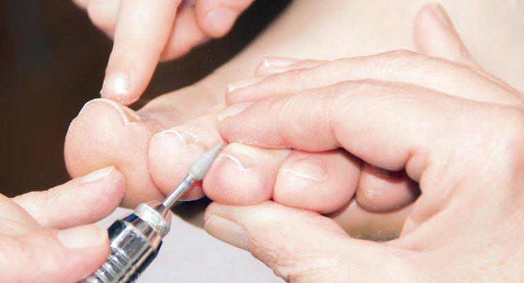 Jak usunąć wrastający paznokieć?