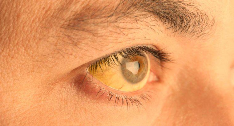Co powoduje, że skóra pod oczami staje się żółta?