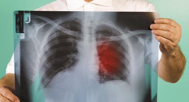 Jakie są pierwsze oznaki raka płuc?