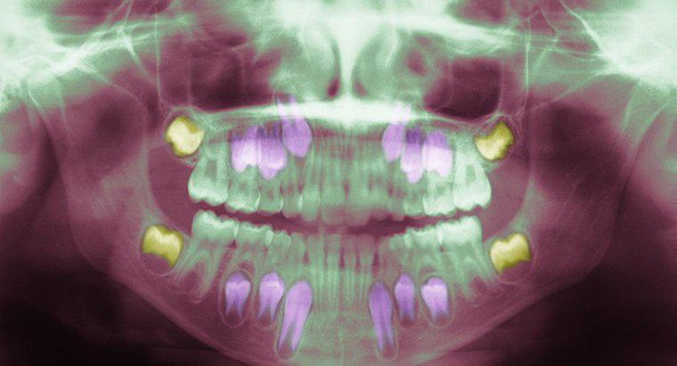 Co powoduje infekcję zębów mądrości?